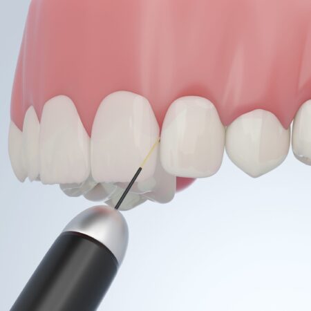 Dental reshaping tooth reshaping & contouring