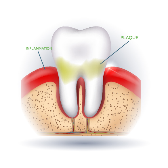 Gingivitis - Early Stage Gum Disease
