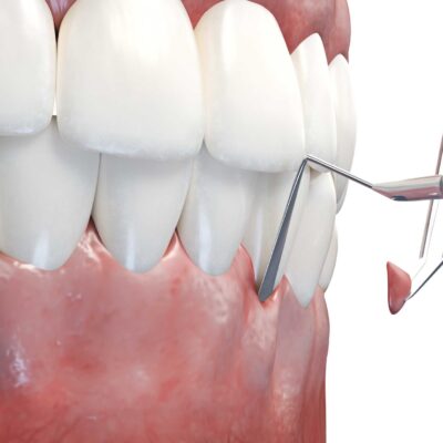 Gum Grafting surgery