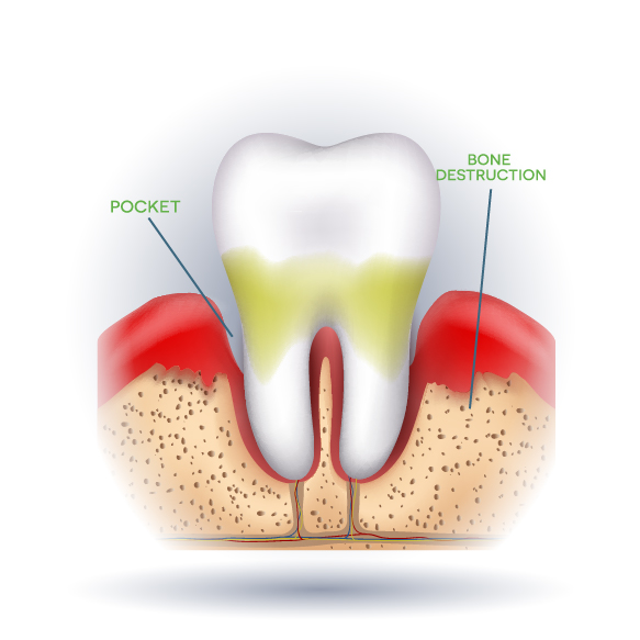 Periodontitis - Moderate Gum Disease