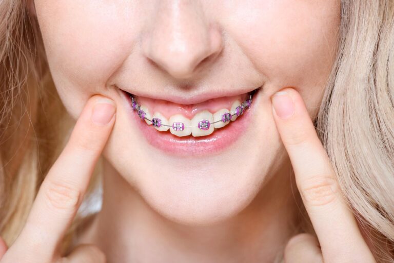 Braces in Winnipeg Dental Clinic