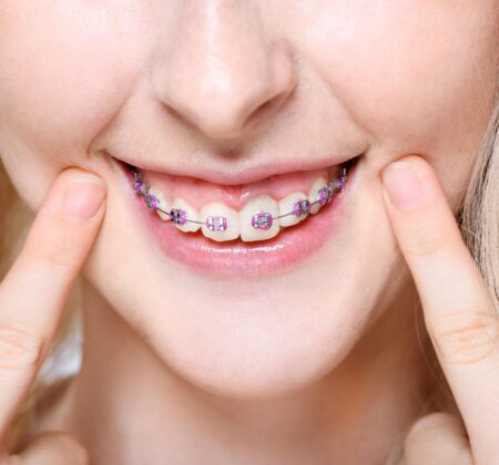 woman smiling with her braces