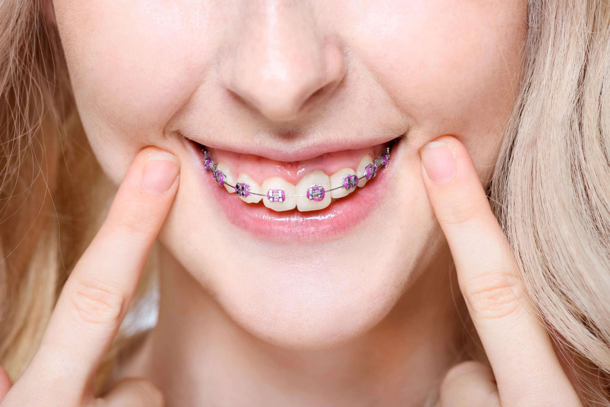 Braces in Winnipeg Dental Clinic