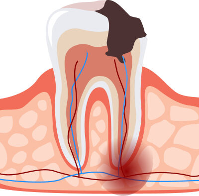 PERIODONTITIS