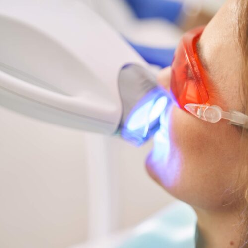 woman-receiving-laser-whitening-treatment teeth whitening
