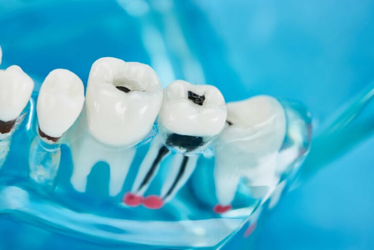 Are Dental Fillings Covered by Insurance in Canada? A Friendly Guide for Patients