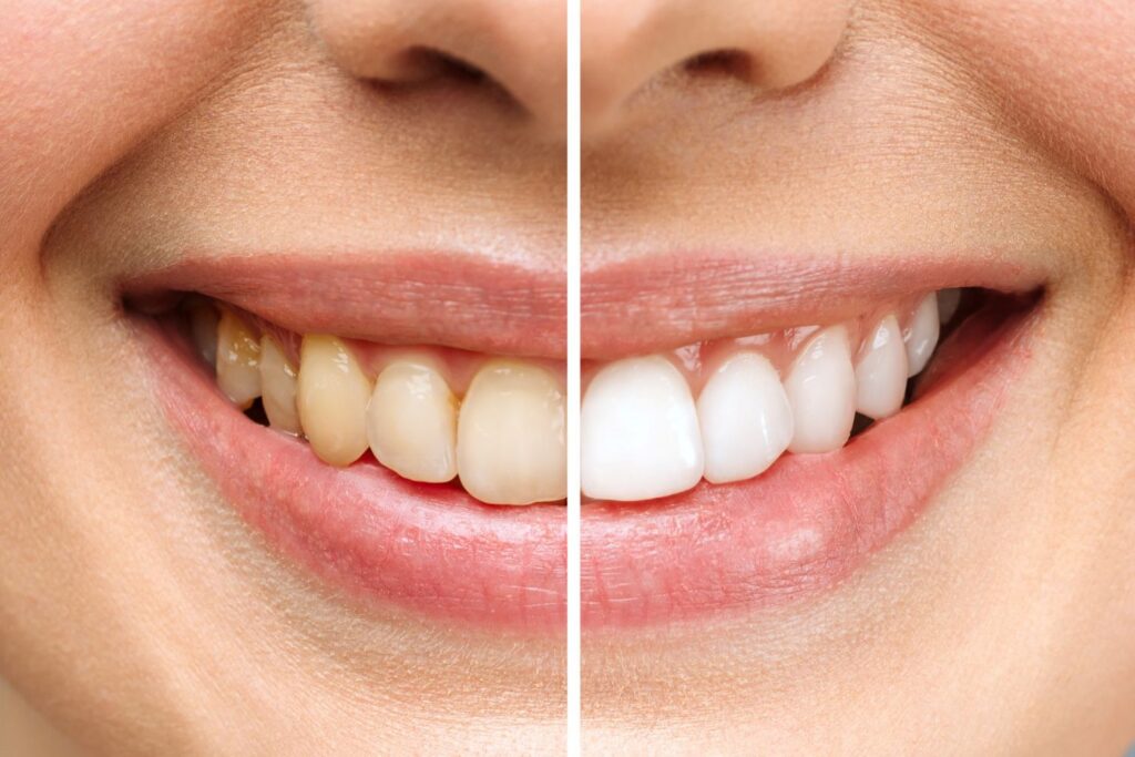 before and after teeth whitening results