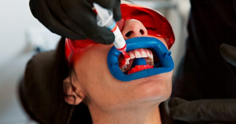 Store-Bought vs. Professional Teeth Whitening: Why the Dentist’s Way Lasts Longer